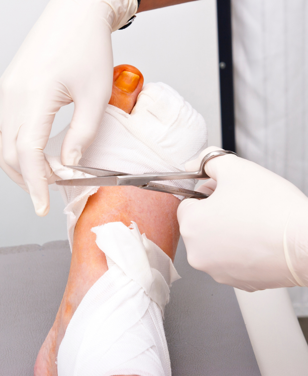 Tratamento de Feridas Crônicas com necrose aplicando pomada desbridante (Colagenase), serviço de enfermagem especializada Sanacurativos.